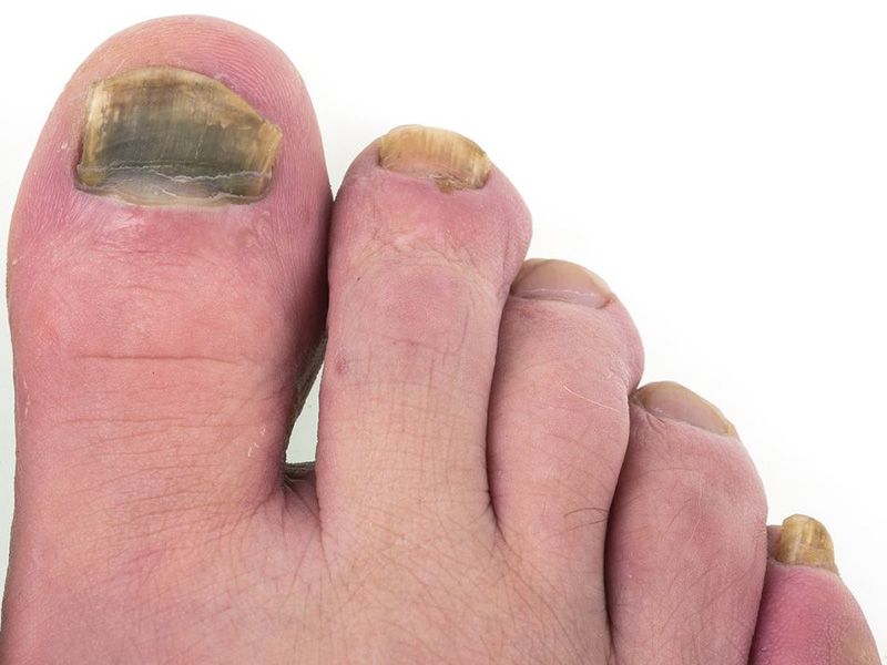 Permalink to Another Downside of Weight Gain: Toenail Fungus. 